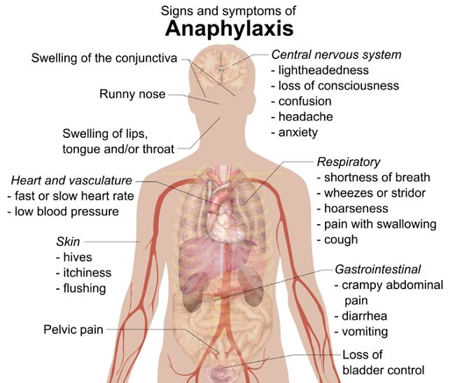Signs and symptoms of Anaphylaxis