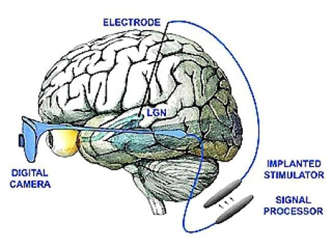 The Cortical Implant Approach for developing the bionic eye