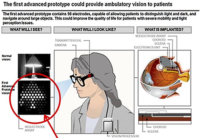 The Bionic eye like the bionic ear will soon be a reality offering vision for the blind and partially blind