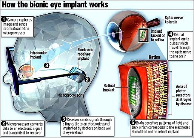 The Epiretinal Approach for developing the bionic eye