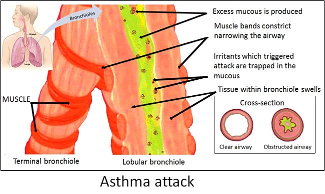 How asthma affects breathing
