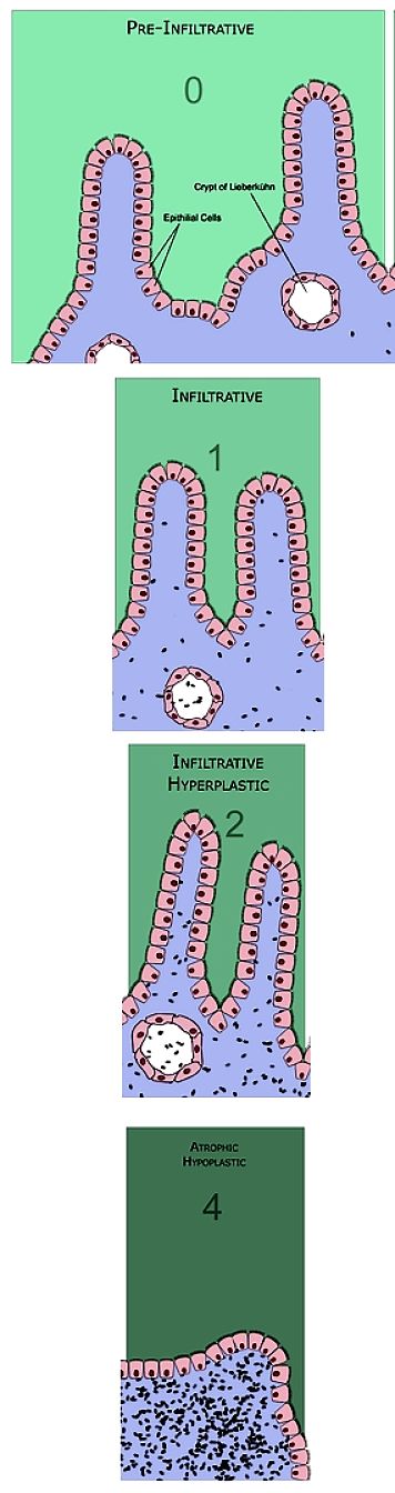 The Stages of Coeliac Disease