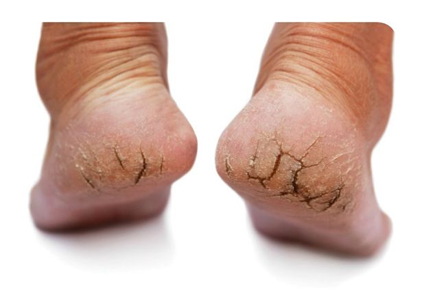 Badly cracked heels require urgent and thorough treatment - especially to remove the build up of dead skin