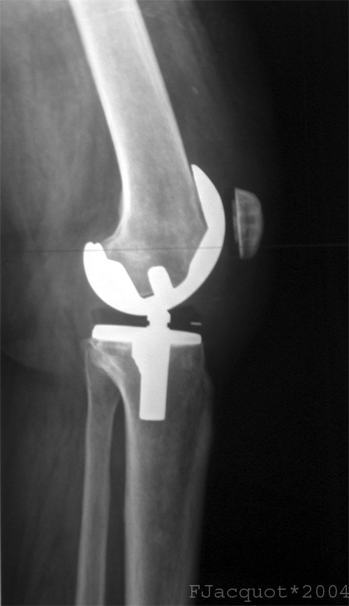 Lateral view of a total knee prosthesis taken from a radiograph 