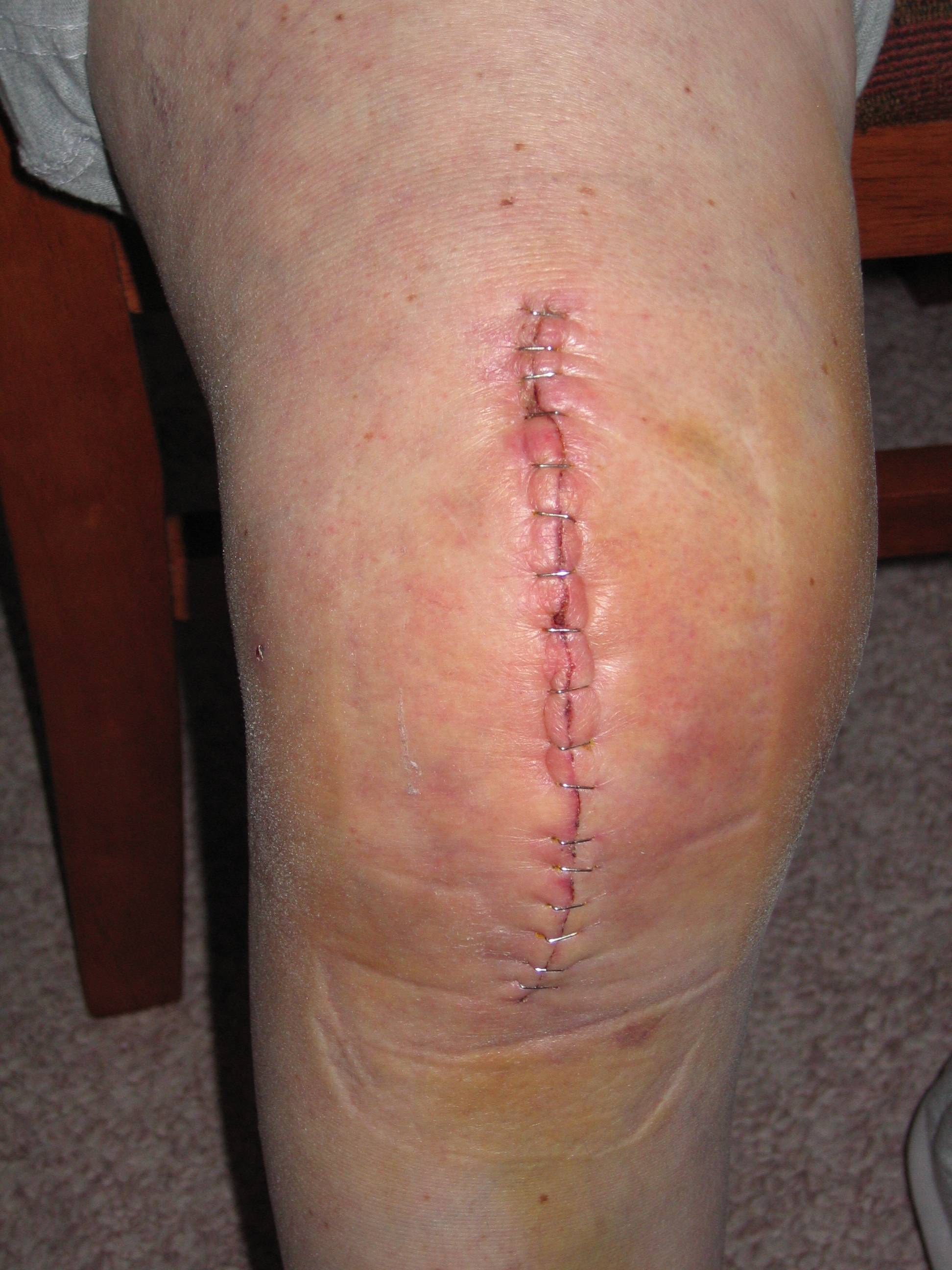 Knee Replacement wound close by staples 