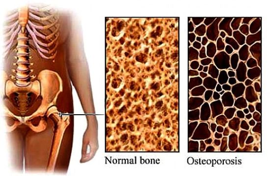 What is osteoporosis - find out more here