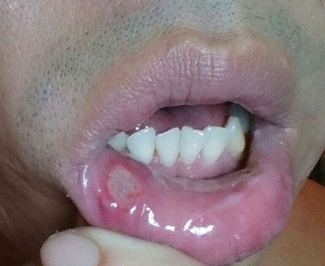 Mouth ulcers are common just inside the lips