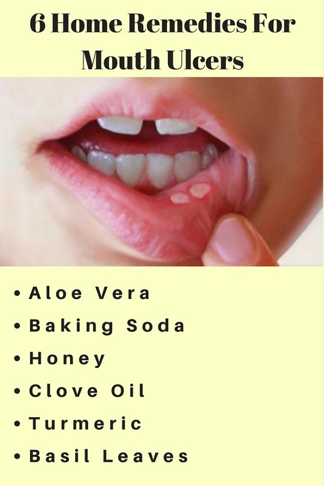 Six home remedies for mouth ulcers