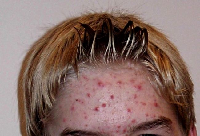 Teenager with acne