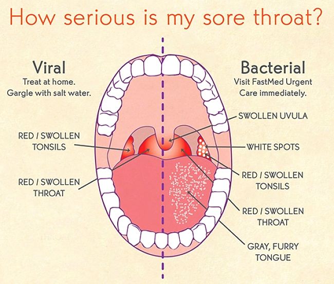 The treatment depends on the cause and severity of the sore throat