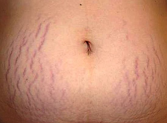 Stretch marks can be eliminated using natural remedies - See this definitive guide