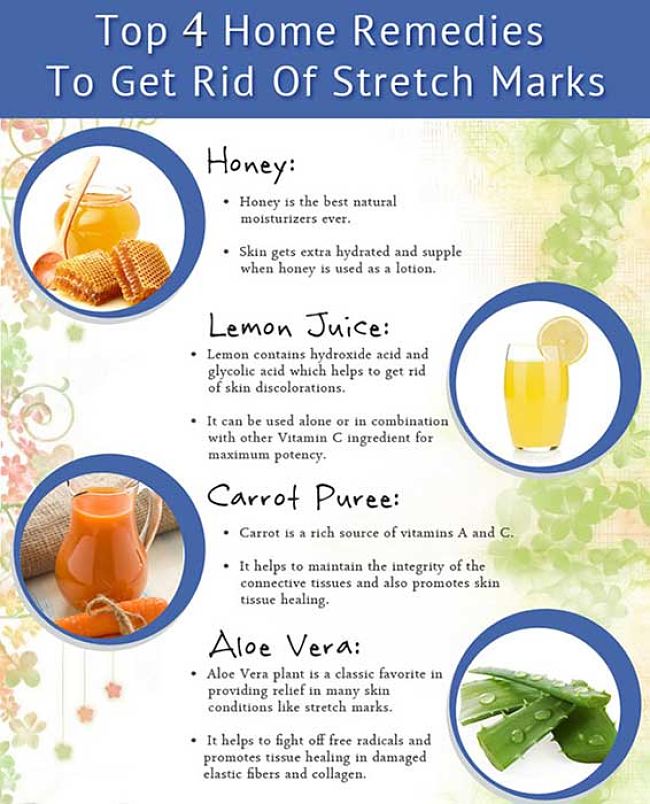 Four natural remedies for Stretch Marks